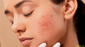 jenis-jenis jerawat